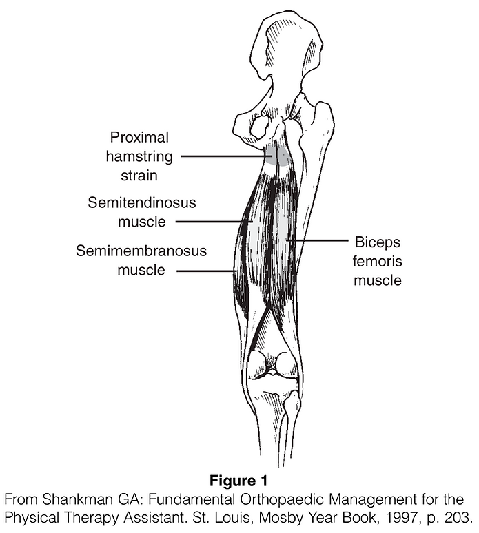 Hamstring Strain.png
