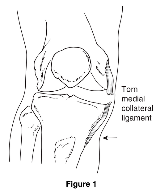 Medical Collateral Ligament