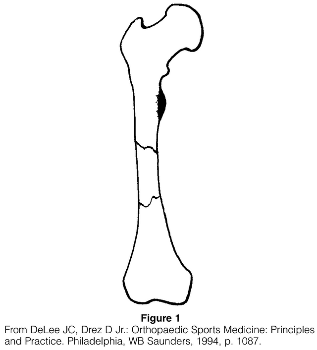 FEMORAL SHAFT STRESS FRACTURE