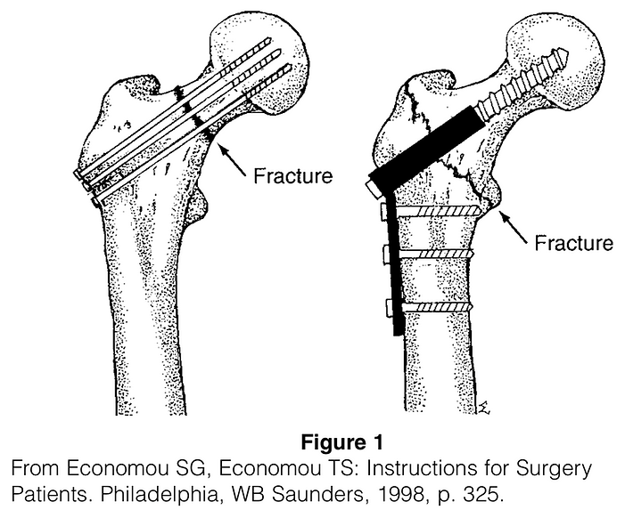 Hip Fracture