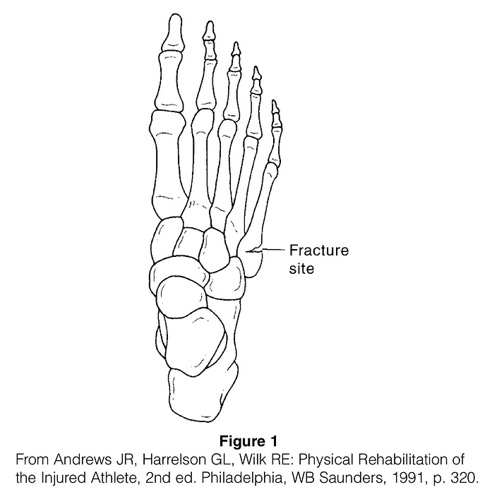 Metatarsal Fracture
