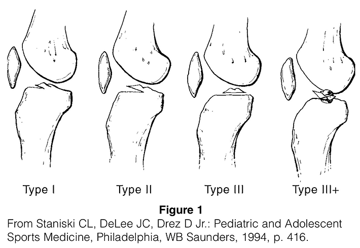Tibial Imenince Fracture