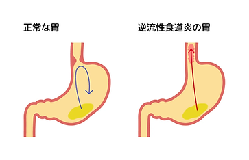 逆流性食道炎.png