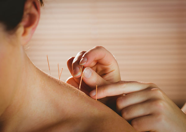 woman receiving acupuncture in her shoulder