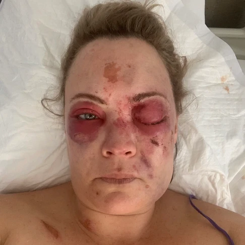 Gina in the hospital after her accident, both eyes are severely bruised. Visual impairment, one eye gang  