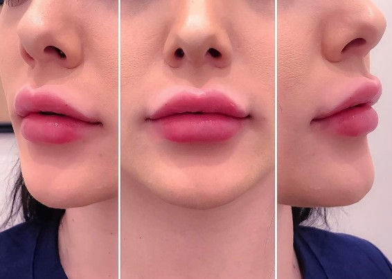 Lip Filler Results, Improved Symmetry And Shape