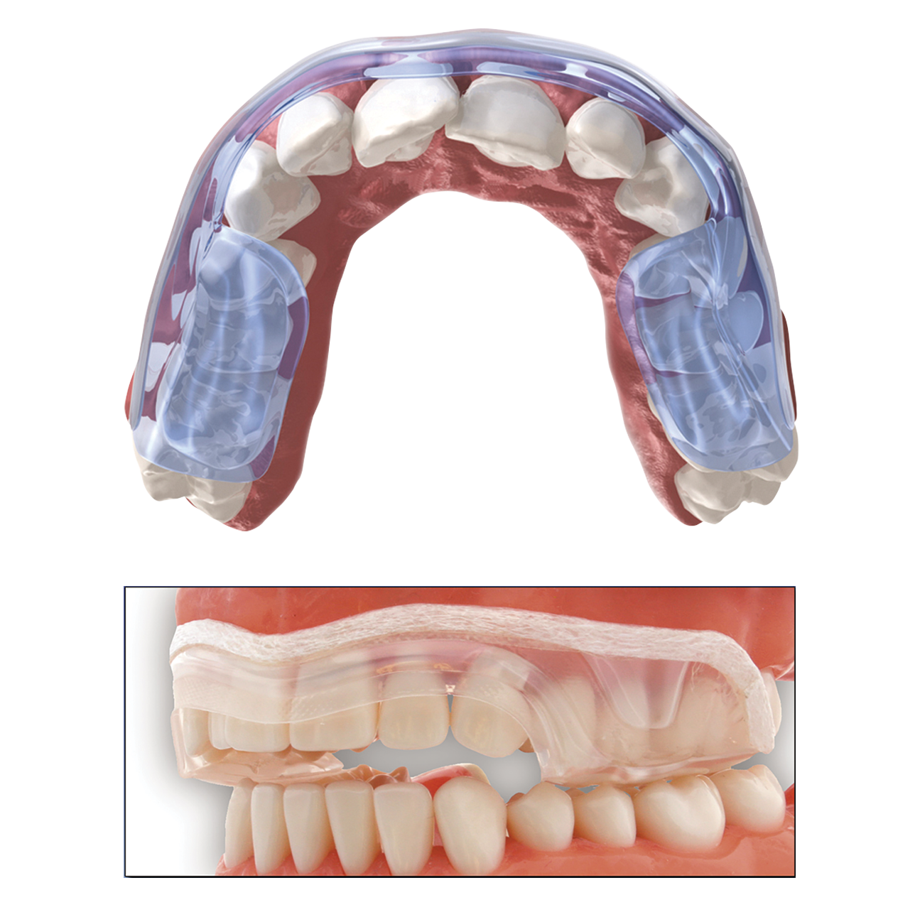 Aqualizer water dental splint