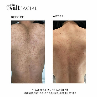 SaltFacialBeforeAfter7-scaled.jpg