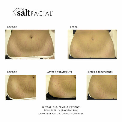 SaltFacial_BeforeAfter2_sample3-1-scaled.jpg
