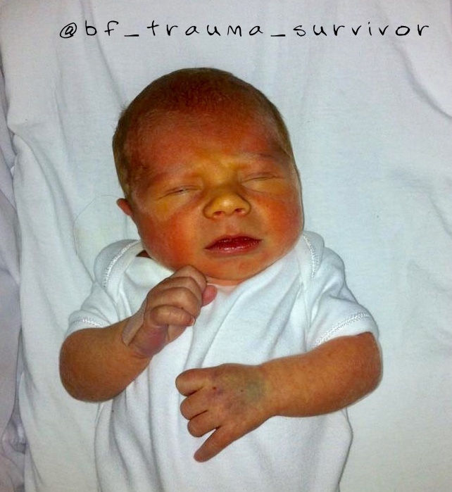 A Breastfeeding Trauma Survivor