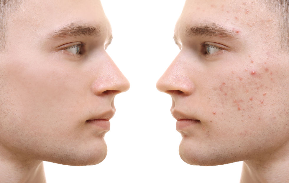 Man with and without Acne
