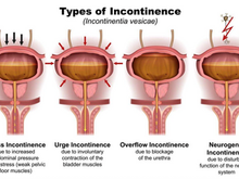 What You Need To Know About Urinary Incontinence in Singapore: Causes, Types, and Physiotherapy Treatment Guide