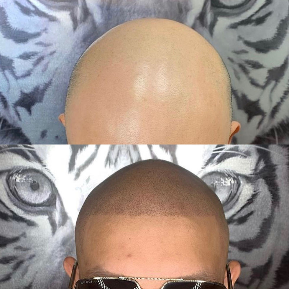 Scalp Micropigmentation