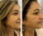 Before and after NMS Face treatment