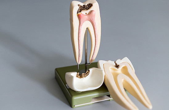 endodontia-especialidade-trata-lesoes-e-doencas-da-polpa-e-raiz-do-dente.jpg