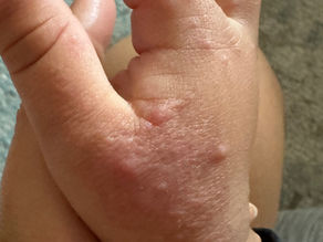 Hand Foot Mouth Disease, a Childhood Illness