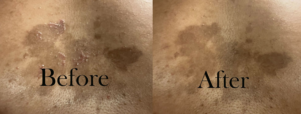 Miniatura: Fungi Fixer: Athlete's Foot, Ringworm, Jock Itch, Tinea Capitis