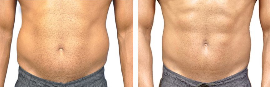 Emsculpt-before-and-after-man_edited.jpg