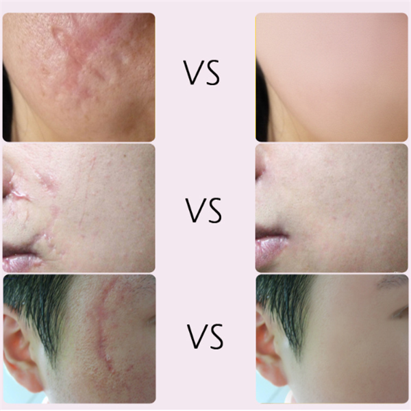 Thumbnail: Acne Scar Removal Cream for Skin Repair and Healing