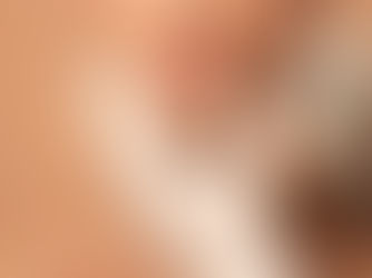 SCULPTRA® vs RADIESSE®: diferencias entre los dos bioestimuladores líderes