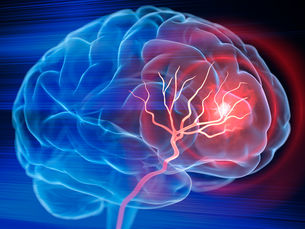 Predicting Stroke Recovery with Artificial Intelligence: The Future of Personalized Neurorehabilitation