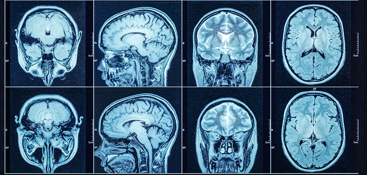 Closeup of a CT scan with brain. Medical
