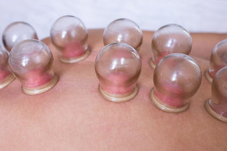 Dry Needling: Is it a Safe Practice? What You Need to Know Before Trying
