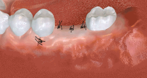 Suturing the implant wound.gif