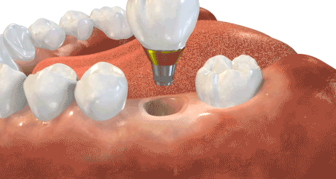 Dental crown on implant.gif