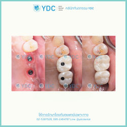 implant10