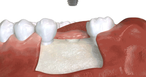 Dental implant.gif