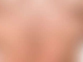 La viruela del mono sigue multiplicándose