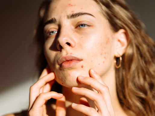 Understanding Functional Approach to Acne: What Your Skin Is Trying to Tell You