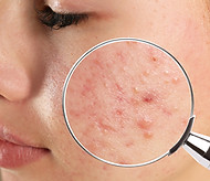 Holistic acne treatment supporting skin and gut health