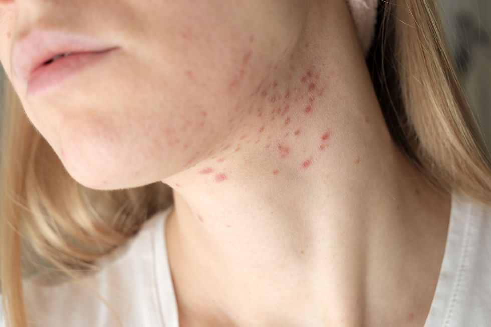 Hormonal Acne - Neck and Jawline