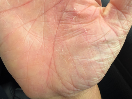Eczema: My Lived Experience as an Aesthetic Nurse (And What Finally Helped)
