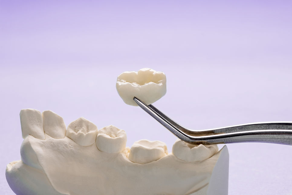 closeup-prosthodontics-prosthetic-single-teeth-crown-bridge-equipment-model-express-fix-re
