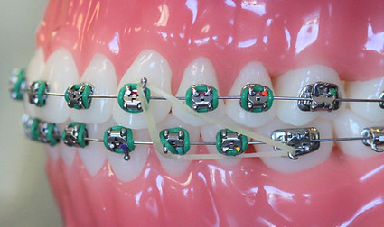 orthodontic-rubber-bands-class-2-triangl