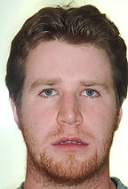 surgical-orthodontics-kingston-21_edited