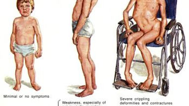 DuchenneMuscularDystrophy.jpg