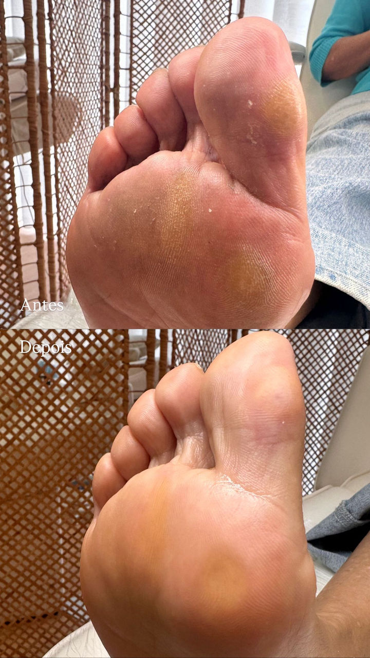 Pedicure Calista - remoção de calos