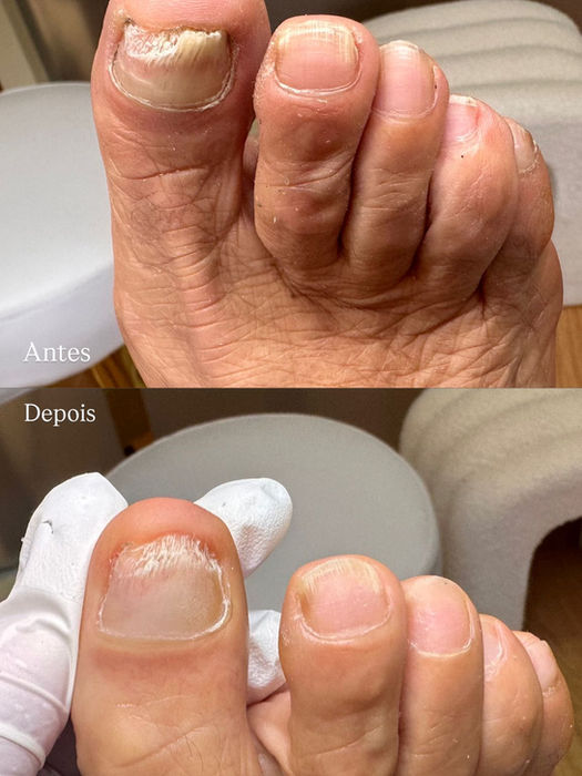 Antes e Depois