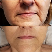 Before and After