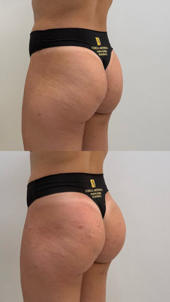Perfil corporal em registro de avaliação estética — Clínica Antonioli, Vila Mariana