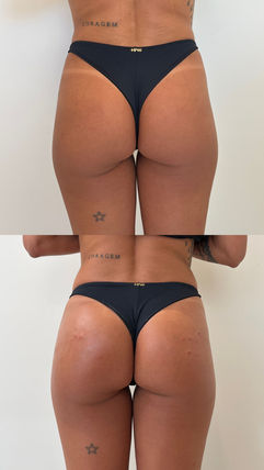 Vista posterior do corpo em registro fotográfico — Clínica Antonioli, Vila Mariana