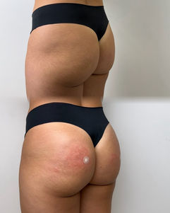 Registro fotográfico de glúteos em vista posterior — Clínica Antonioli, Vila Mariana