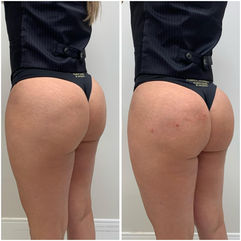 Registro posterior da região glútea em avaliação estética — Clínica Antonioli, Vila Mariana