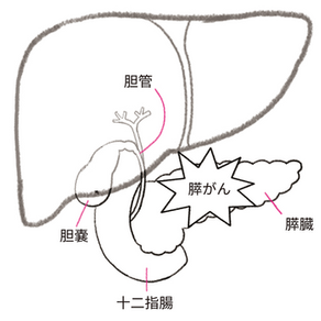 膵臓がん