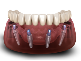 The ACTUAL Cost of Full Mouth Dental Implants - (2022 Updated)
