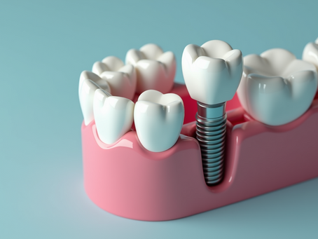 Discovering Dental Implant Solutions in Sherwood Park